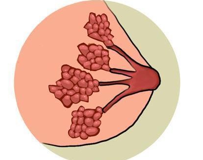 乳腺增生到底要不要治疗？